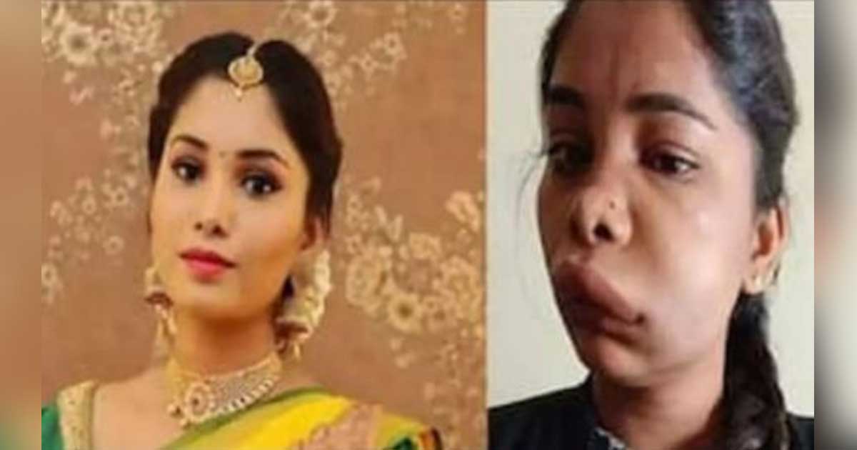 Kannada Actress Swathi Sathish Shared Photos Post Her Root Canal Surgery That Went Wrong