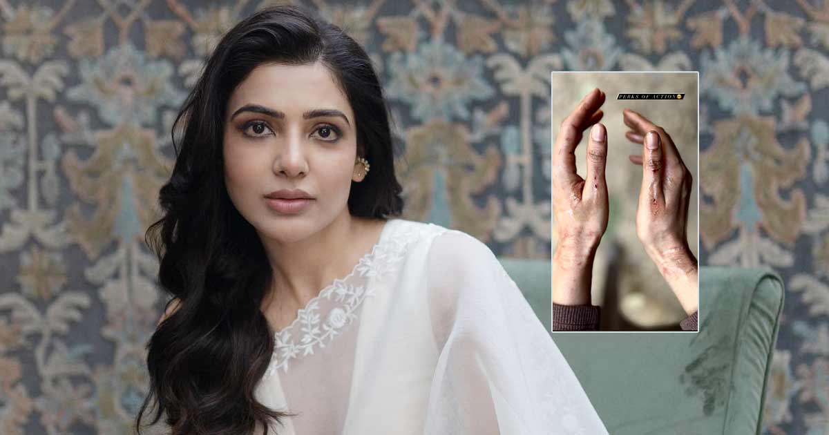 Samantha Ruth Prabhu Shares Pictures Of Bruised Hands From 'Citadel' Shoot